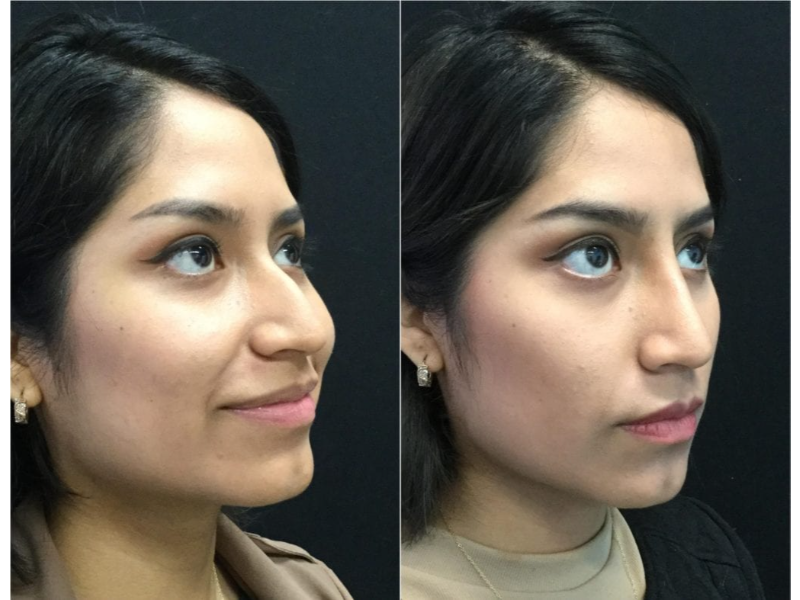 25137-20170522_Oblique-Canvas-non-surgical-rhinoplasty-1024x787