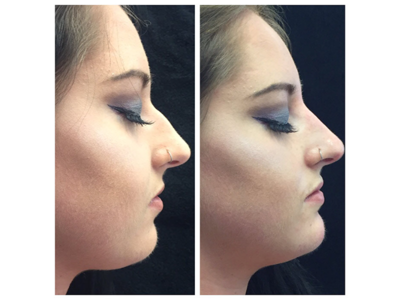 Non-Surgical-Rhinoplasty-Before-and-After