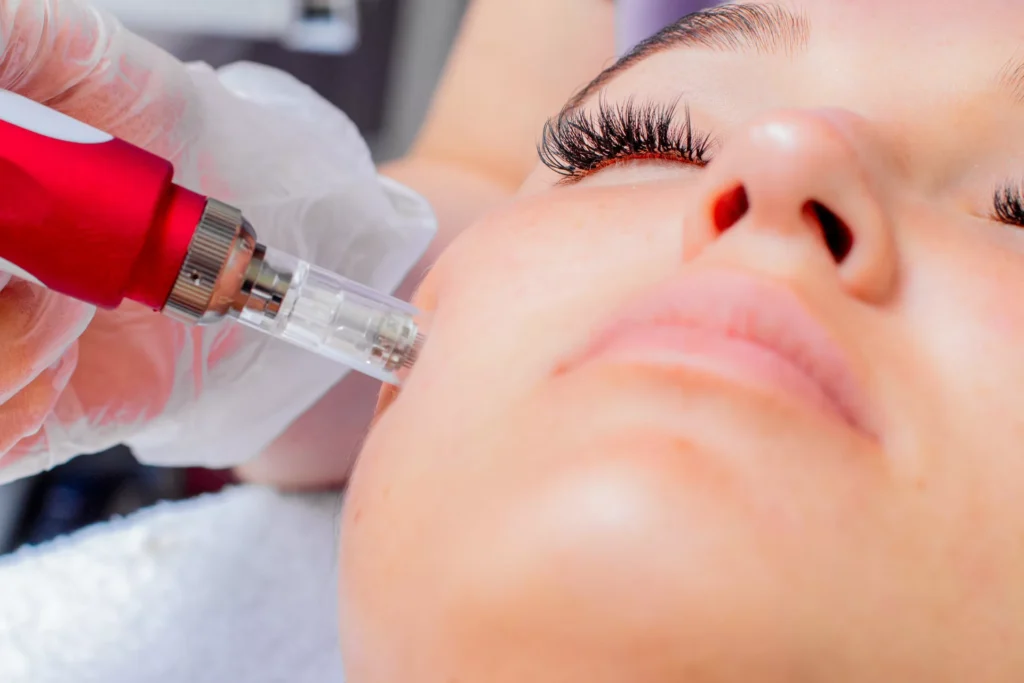 artemedica_featured_vivace-microneedling-jpg