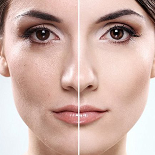 dermaplaning-before-after