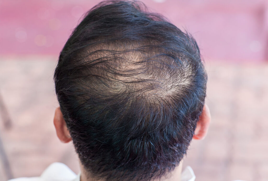 stop-hair-thinning-and-prevent-balding-feat-1